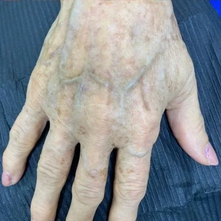 Hand rejuvenation — After