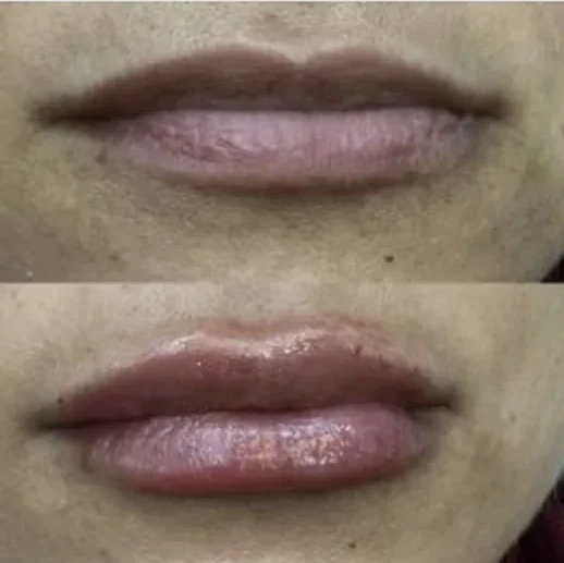 Lips — After