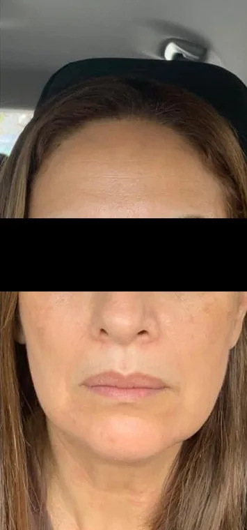 Facial pigmentation and skin quality — After