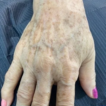 Hand rejuvenation — Before