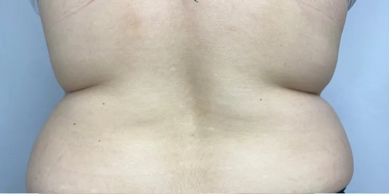 Flank and lower back — Before