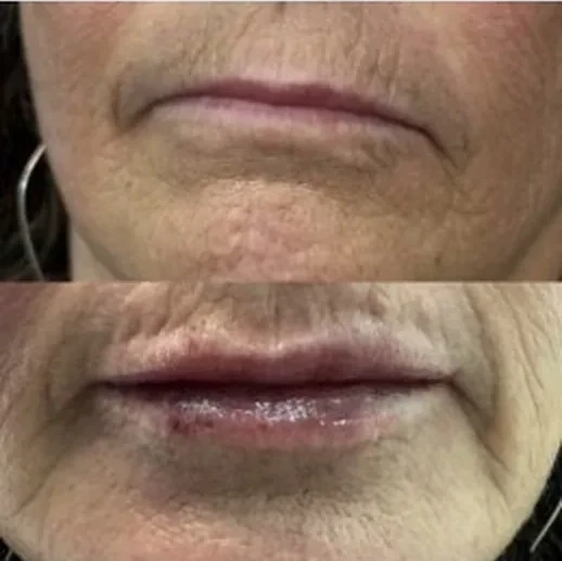 Lips — Before