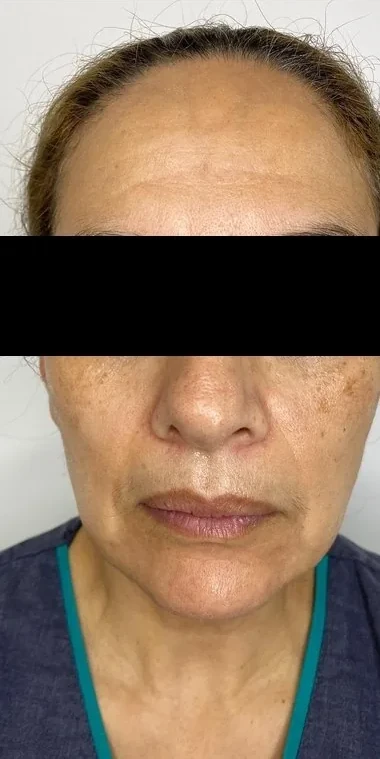 Facial pigmentation and skin quality — Before