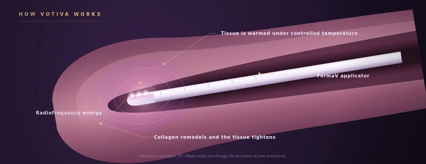 A schematic of how Votiva works — the applicator inside the canal, radiofrequency warming the tissue wall so collagen remodels