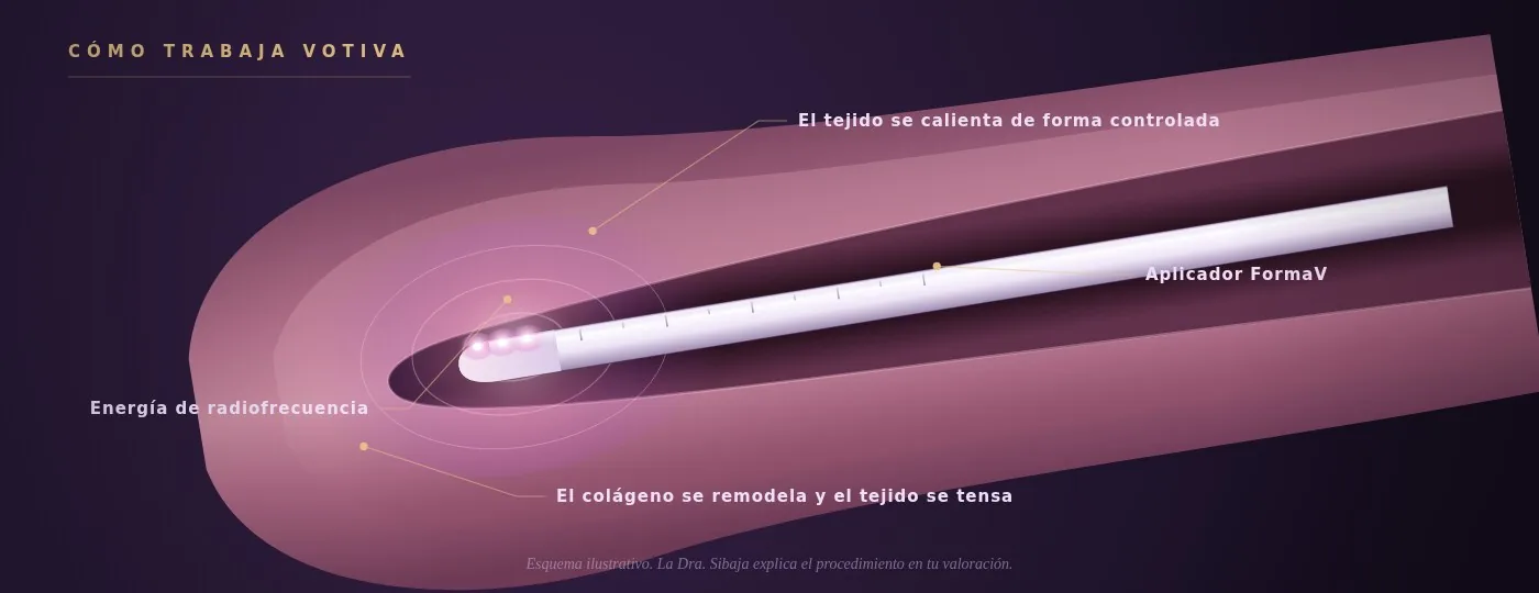 Esquema de cómo funciona Votiva — el aplicador dentro del canal, la radiofrecuencia calentando la pared del tejido para que el colágeno se remodele